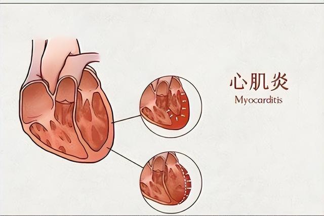 心肌炎的癥狀有哪些？心肌炎的主要變現(xiàn)癥狀有啥？